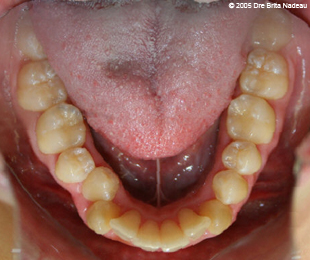 Marie-Hélène Cyr - Lower occlusal view - Before orthodontic treatments and orthognathic surgeries (November 24, 2005)